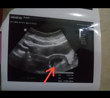 Sharing hasil usg 7week