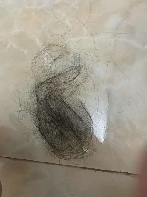 Rụng tóc sau sinh