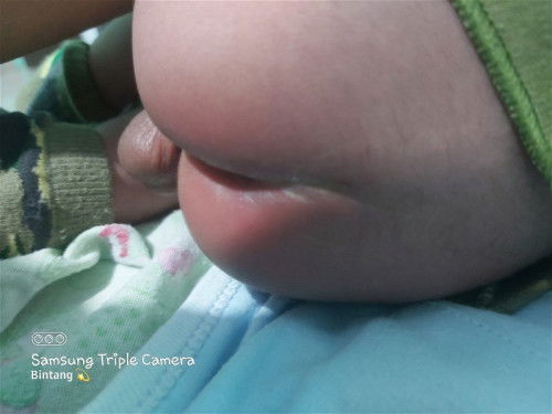 Iritasi pantat bayi umur 22 hari