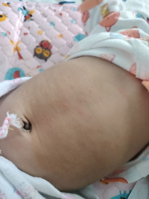 ท้องน้องเป็นผื่นแบบนี้