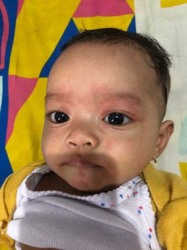 biang kringat kemerahan