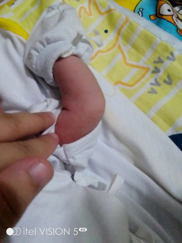 Rushes na tumubo sa 1 week old kong baby