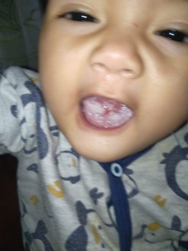 Lidah putih pada bayi