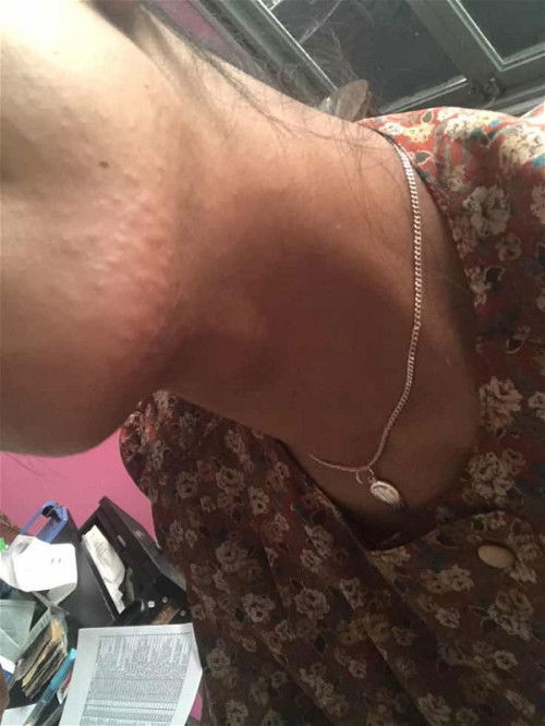 Gatel di wajah dan leher, saat hamil 13 minggu kenapa ya ? Apakah alergi ?