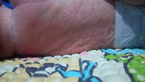 Masalah kulit bayi newborn