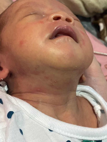 สิวทารก หรือ ผดผื่นคะ