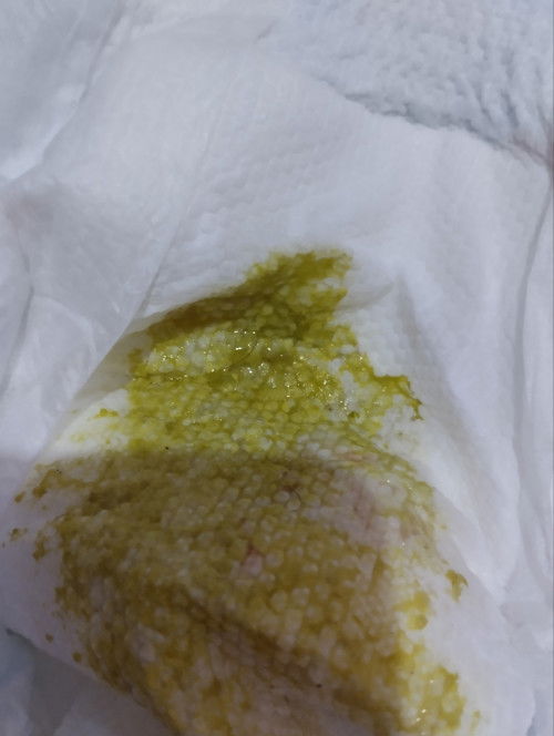 Pagtatae ni LO (11 months old)