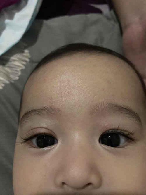 mata bayi bengkak sebelah