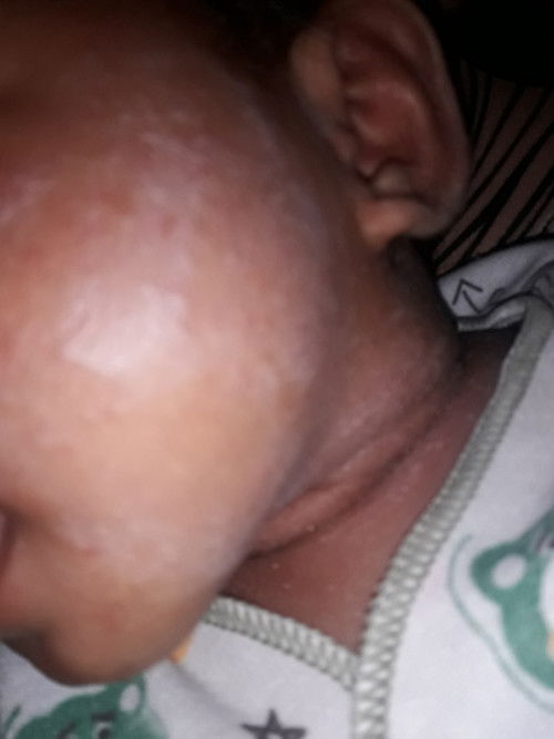 Ruam pada muka dan leher