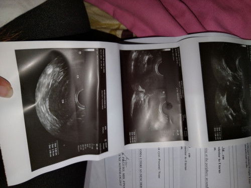 Myoma and both ovaries pcos