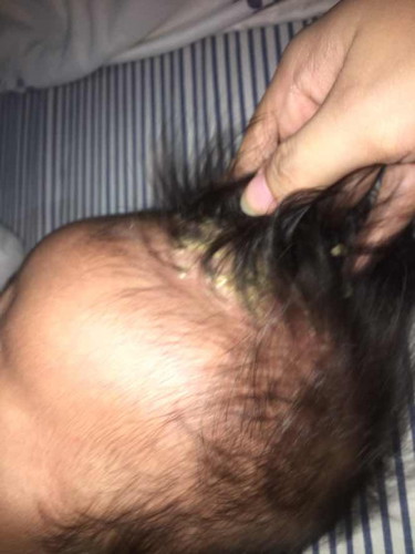 Cradle cap