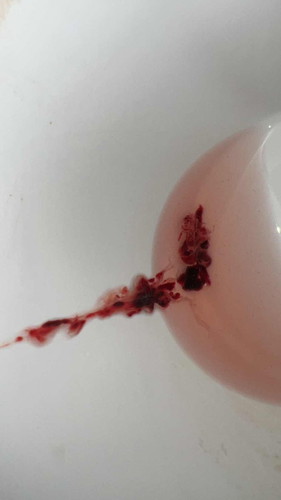 miscarriage at 6 weeks