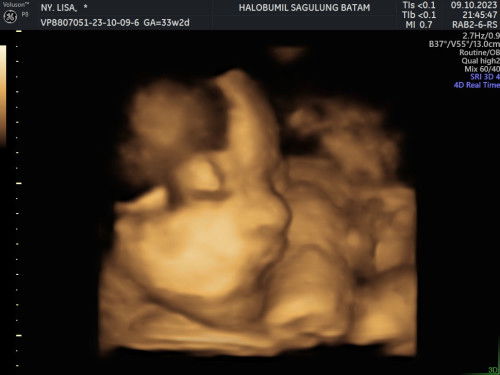 Usg 33w Masha Allah❤️