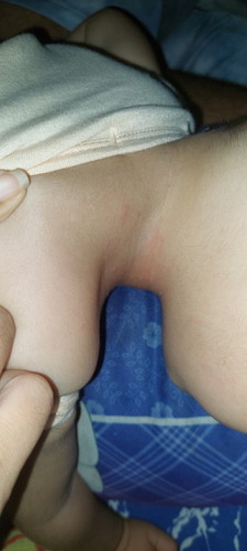 Mn ơi cho e hỏi bé e bị vậy mà ngứa lắm k biết bị gì ạ? Xin các mom cho e lời khuyên.