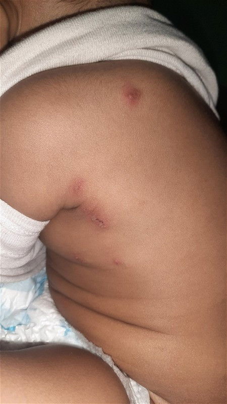 Bruntusan dan melepuh