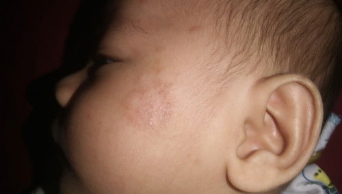 Kulit bintik2 kemerahan dan melingkar