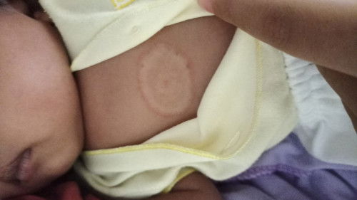 Jamur pada kulit bayi