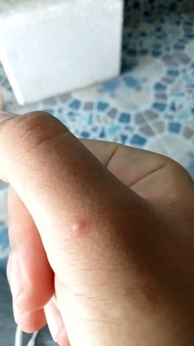 ตุ่มใสแบบนี้อันตรายมั้ยคะ