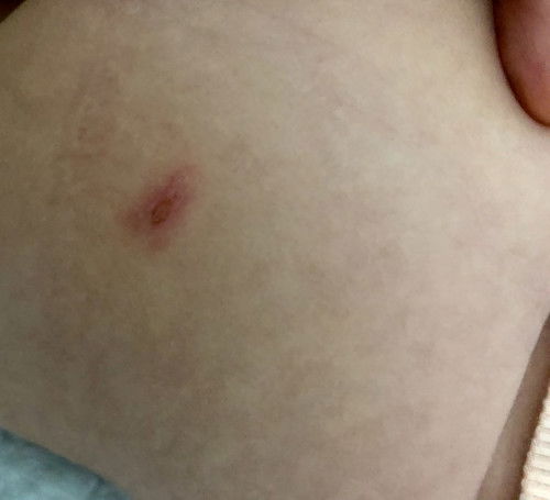 Bị mụn ở mông