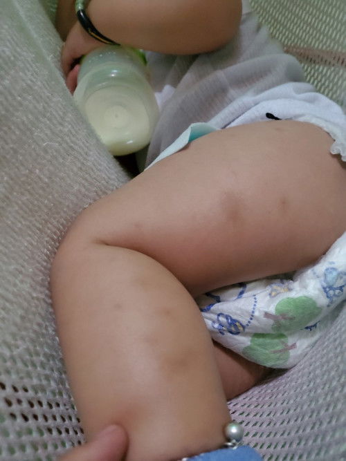 Bagi tips Bund cara hilangin Bekas Gigitan nyamuk pada bayii