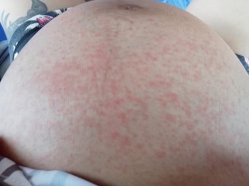 ผื่นอะไรค่ะแม่ๆ