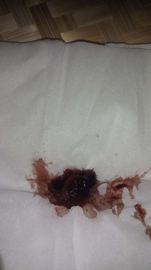 Flek lebih dari 40 hari setelah op sc