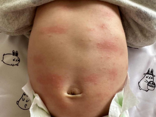 Help! Baby rashes on body