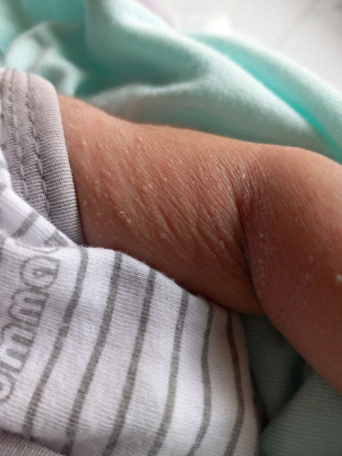 Bintik bintik kecil bernanah