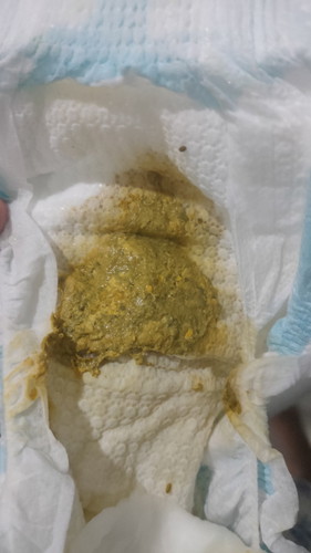 สีอุจจาระลูกแบบนี้ผิดปกติไหมคะ