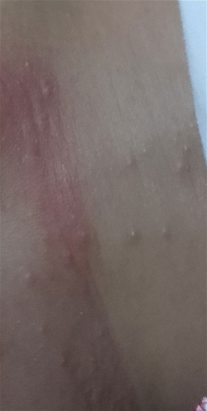 Rashes sa likod? Ano po kaya ito mga mi?