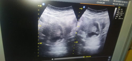 Bun bantu jawab yh perkiraan saya sekarang tuh udh masuk 9minggu Bun tapi pas di USG katanya baru 5m