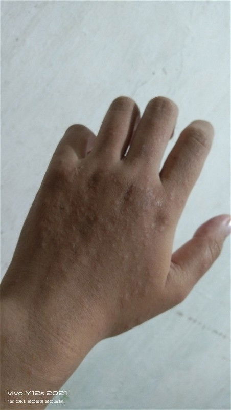 Gatal seluruh badan mendekati hpl