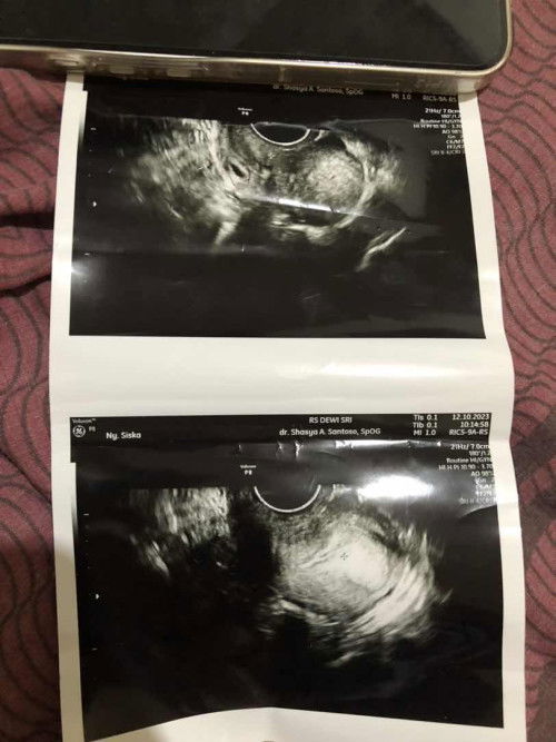 Belum telat haid tapi udah garis 2