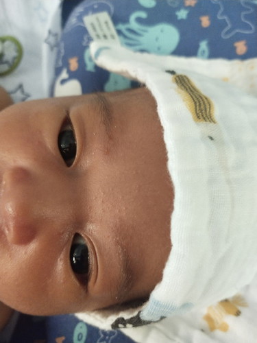 Kening dan kepala bayi ade keruping