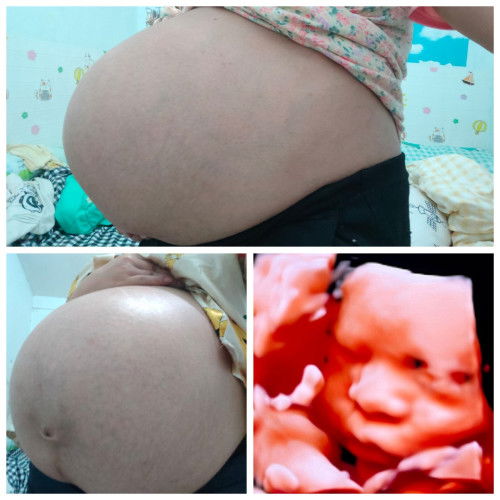 ผ่าคลอดรอบที่3 
35+3 w นน.2800 คุณหมอนัดผ่าคลอด 31 ต.ค ใครก็ทักท้องแหลมท้องใหญ่มาก