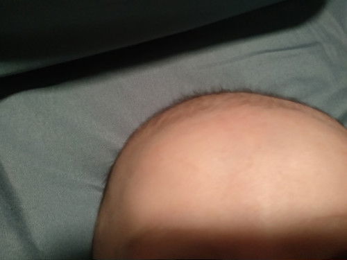 Biang keringat di kepala