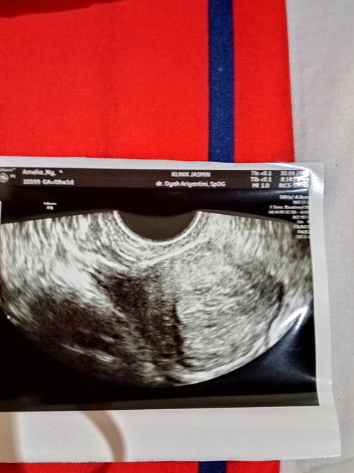 Ingin tahu hasil USG😌