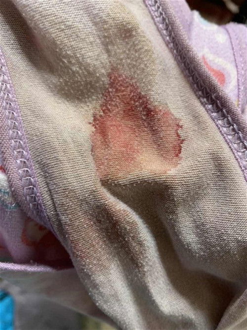 Hamil 10 minggu keluar darah