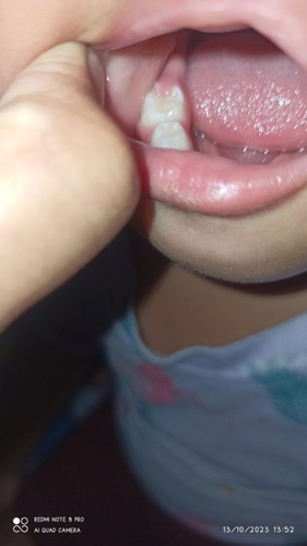 Gusi tumbuh