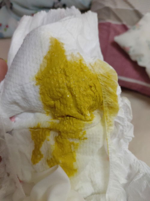 Nagtatae po ba si baby kung ganito tae nia?