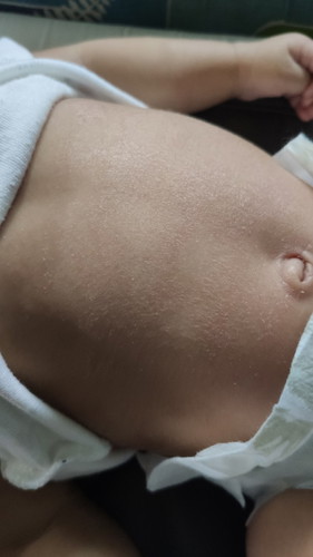 KULIT BAYI KERING
