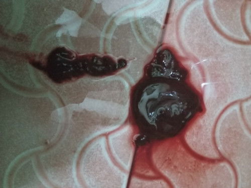 Kehamiln sya 11 minggu kelur flek