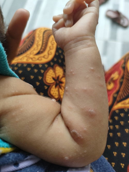 Cacar air pada kulit bayi