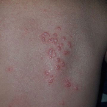 Ruam kulit pada bayi