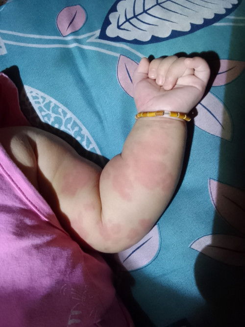 Bé bị mẩn đỏ khắp người