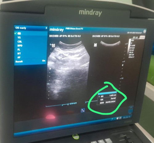 Dua hasil usg yg ber beda