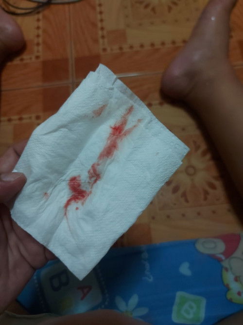 39w+3d มีเลือดออกแต่ไม่เจ็บท้อง  เลยค่ะ ต้องรอก่อนหรือไป รพ.เลยคะ แม่ๆ