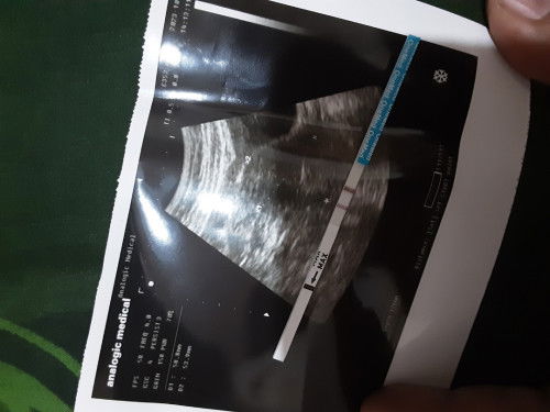 HPHT 31 Agustus, 3 harian ini sempet ngeluarin kyk lendir, dan USG masih penebalan dinding