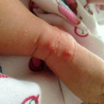 Bintik merah berair dan nanah