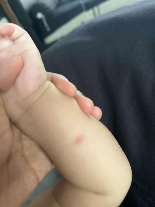 Bentol merah kulit bayi